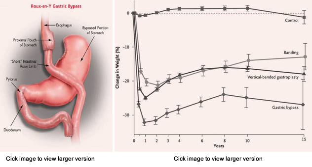 Dramatic Weight Loss Diabetes