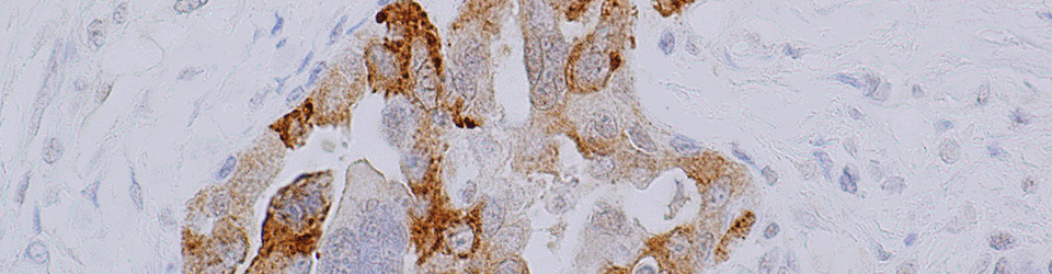OCRC Tumor Bank Core
