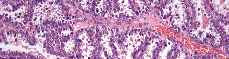 OCRC Tumor Bank Core