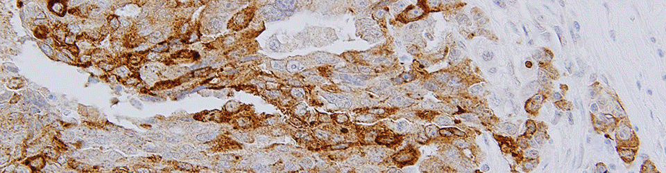 OCRC Tumor Bank Core