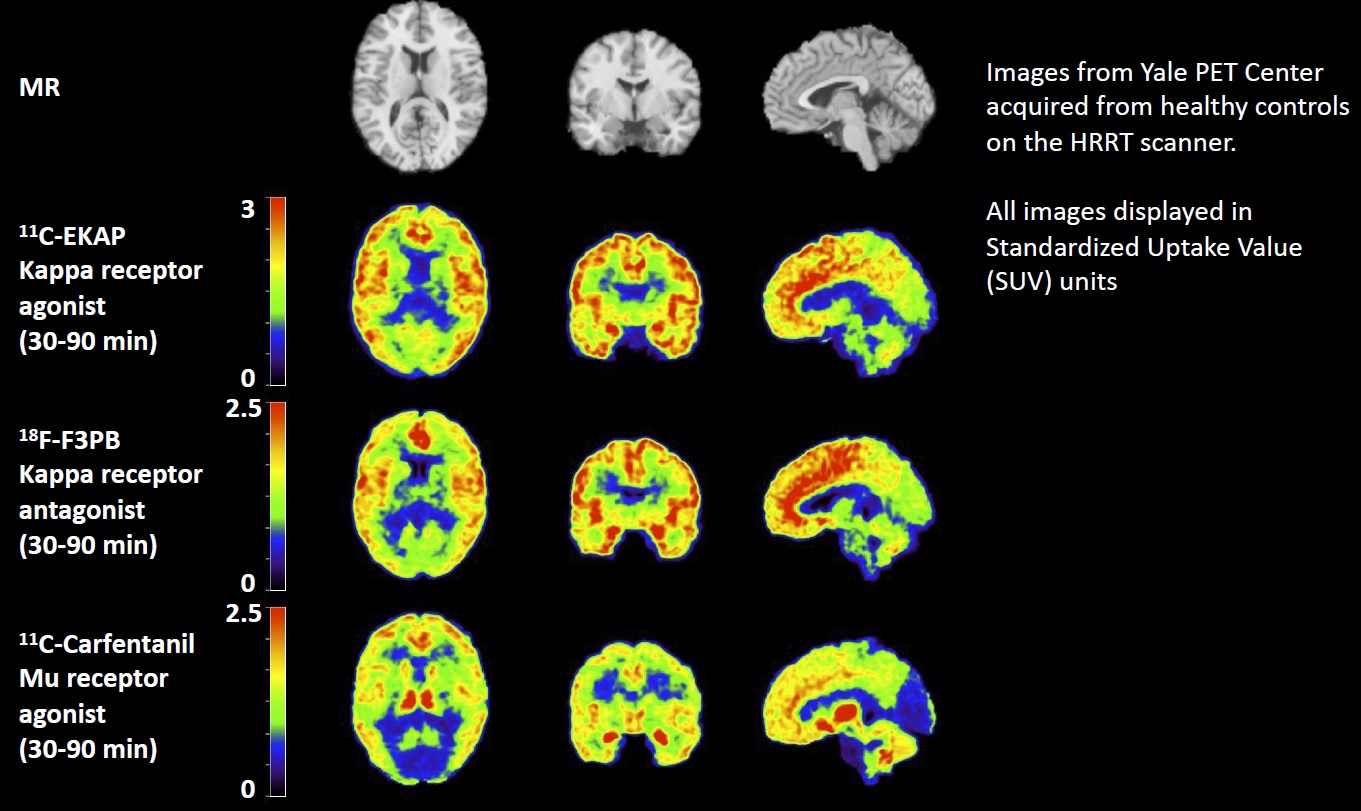 PET Brain Imaging of Opiate Receptors