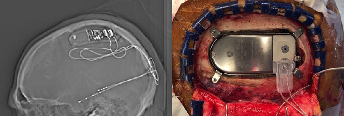 Photos of Neurosurgery