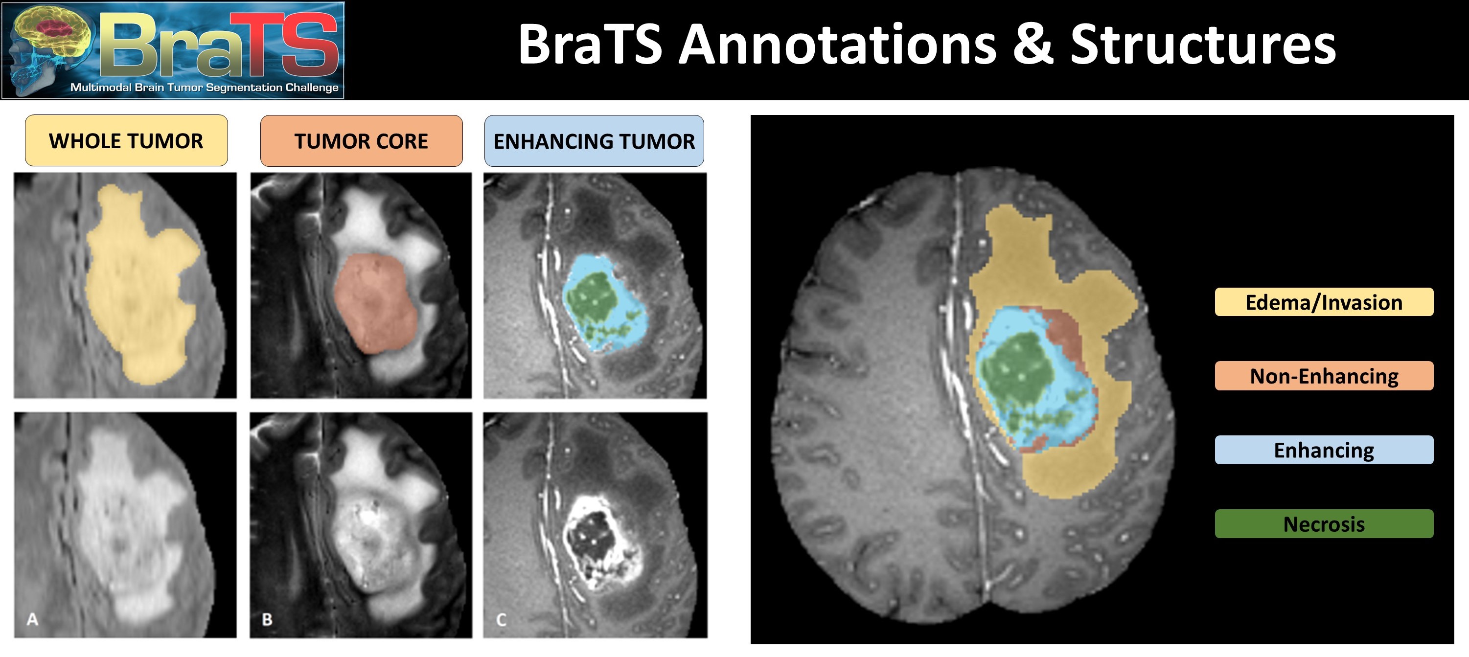 PDF] Brain Tumor Segmentation of MRI Images Using Processed Image Driven  U-Net Architecture