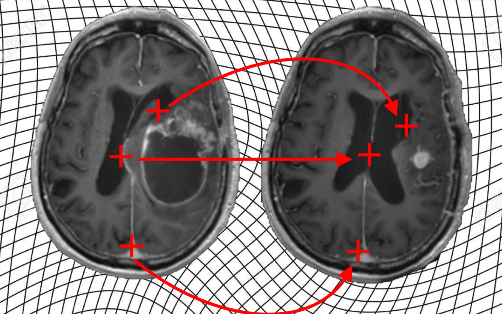 Establishing Correspondence between Pre-Operative and Follow-up MRI