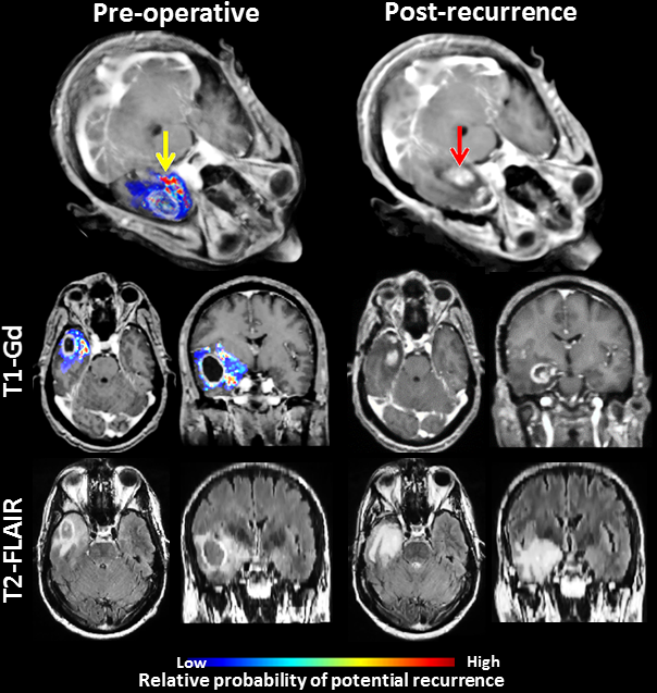 MRI