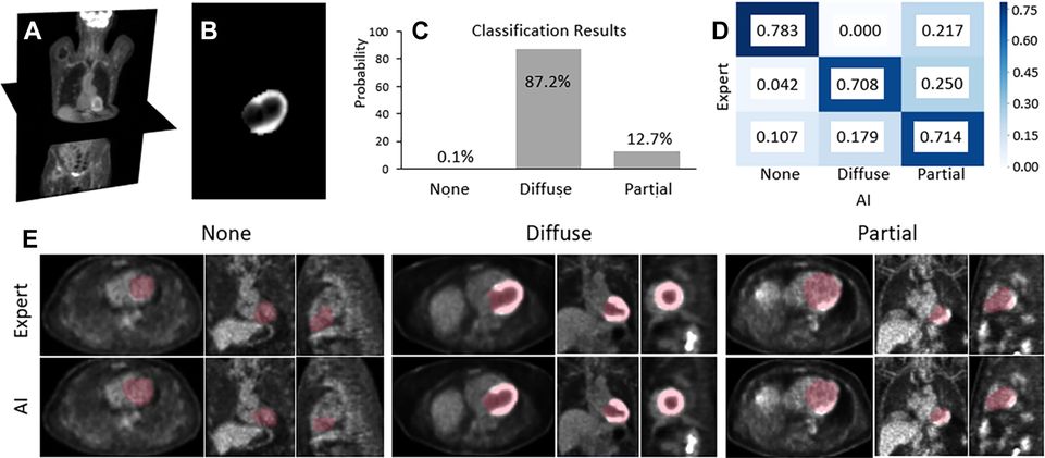 graphic of ML segmentation of the heart on PET