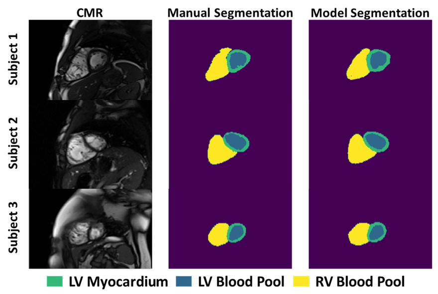 graphic of ML segmentation of the heart on MRI