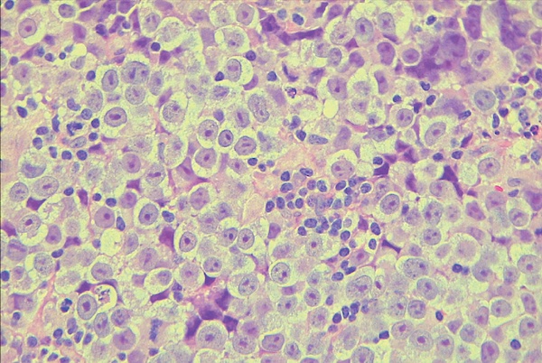 Kotaro Sasaki and his team unveil the genetics of testicular cancer