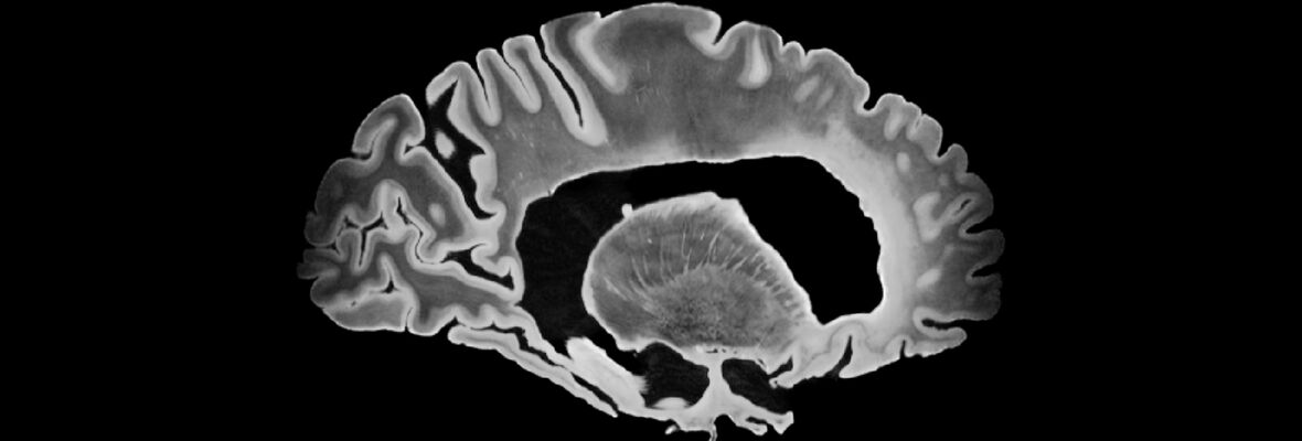 sag brain MRI