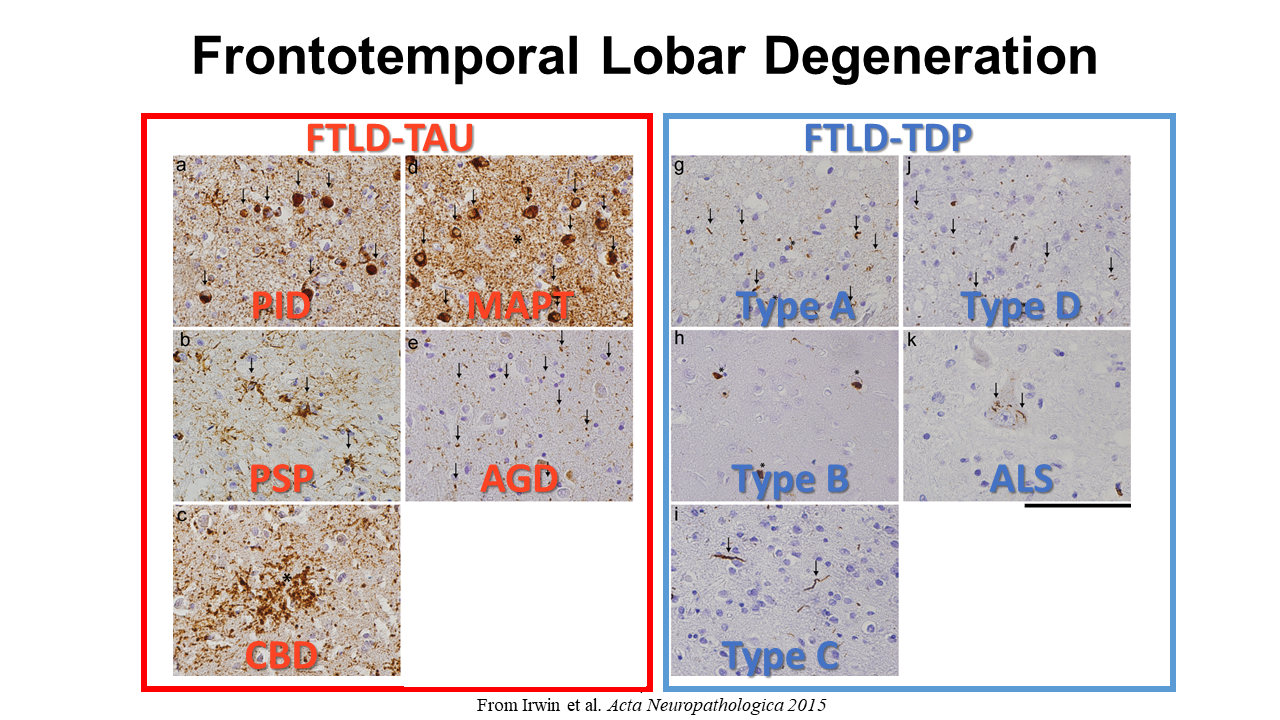 FTLD proteinopathies