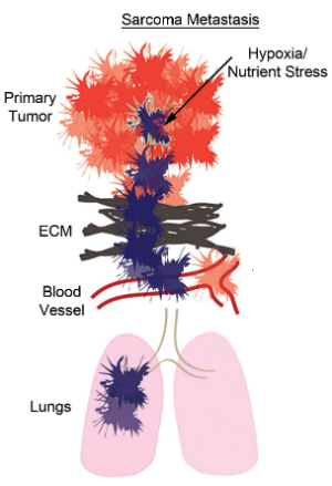 Sarcoma Metastasis diagram