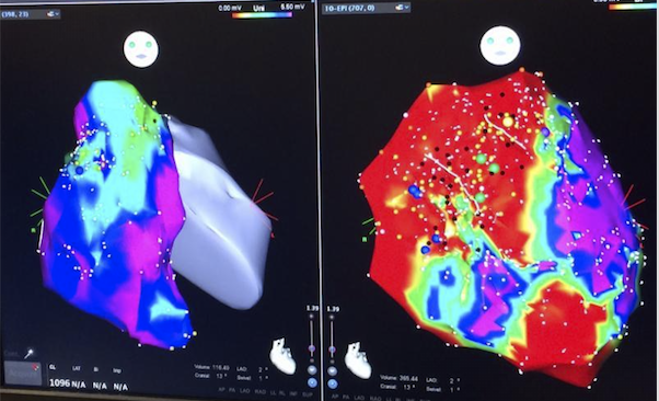 Arrhythmogenic right ventricular cardiomyopathy/dysplasia (ARVC/D)