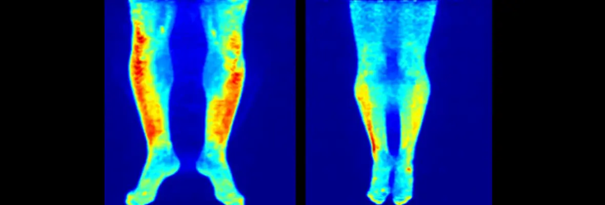 Before and after PET images of psoriasis on legs