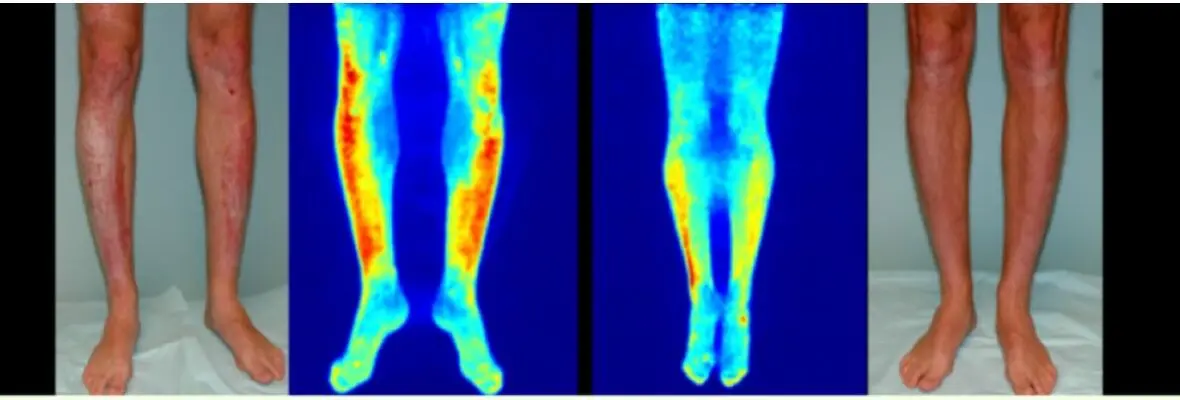 Before and after PET/Clinical images of psoriasis on legs