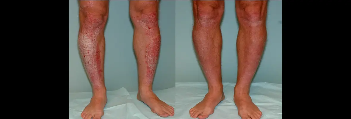 Before and after photos of legs with psoriasis