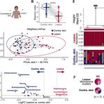 Multiomic profiling of cutaneous Leshmaniasis