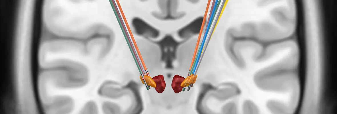 Deep Brain Stimulation Leads
