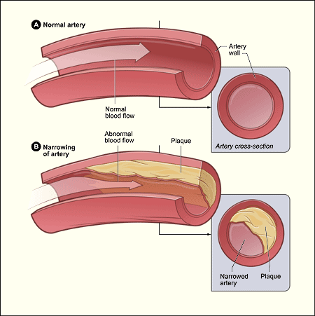 Normal artery and an artery with plaque buildup caused by high cholesterol