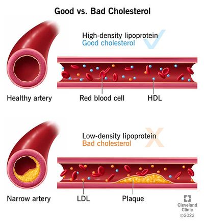 There is good cholesterol or high density lipoprotein and bad cholesterol or low density lipoprotein, which causes plaque in the arteries.