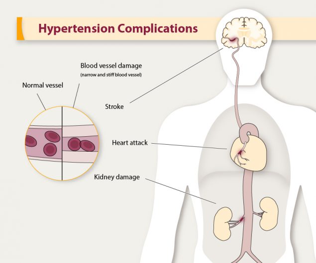 Complications of hypertension include blood vessel damage, heart attack, kidney damage, and stroke.
