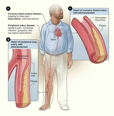 Common side effects of smoking are peripheral and coronary artery diseases