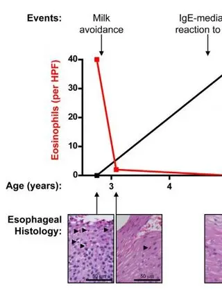 The development of IgE-mediated immediate hypersensitivity after the diagnosis of eosinophilic esophagitis to the same food