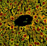Liver cells from mice that do not express FOXA2. (Mutant mice accumulated bile salts and failed to detoxify them properly, which resulted in liver damage.) The liver cells in this image show an accumulation of proteins that are used by cells to degrade unwanted substances. Credit: Klaus Kaestner, PhD, University of Pennsylvania School of Medicine; Nature Medicine