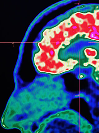 Amyloid-PET Scans Won’t Reduce Alzheimer’s Inequities