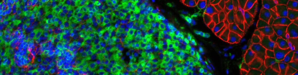 Lymph node versus fat