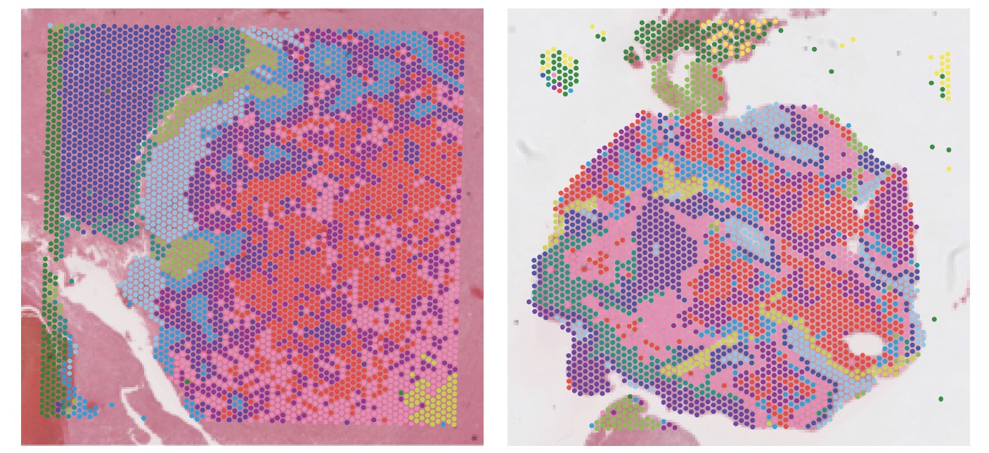 The pathology data sets of two meningiomas with varying degrees of aggressiveness.