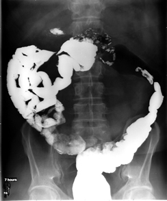 ileocolic fistula