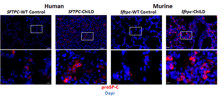 AT2 Hyperplasia in human and murine ChILD