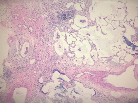 PCLS lung fibrosis histology