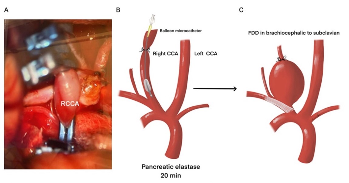 Three panels showcasing the treatment of an aneurysm.