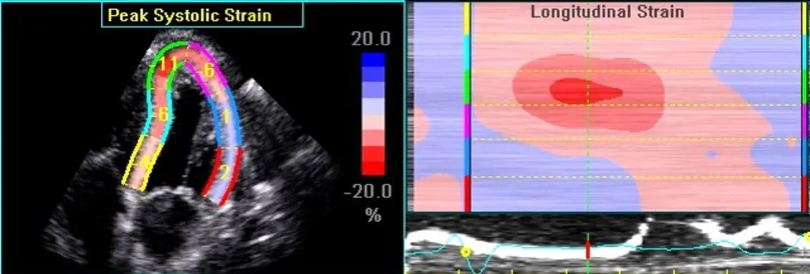 Echocardiogram image showing longitudinal strain.