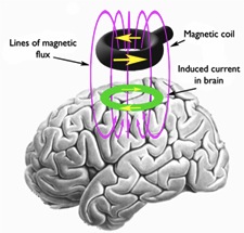 TMS