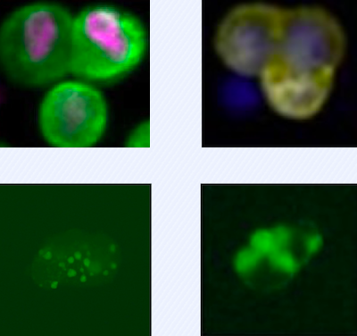 Circulating tumor cells tagged with fluorescent markers to highlight features on surface and interior of cells.