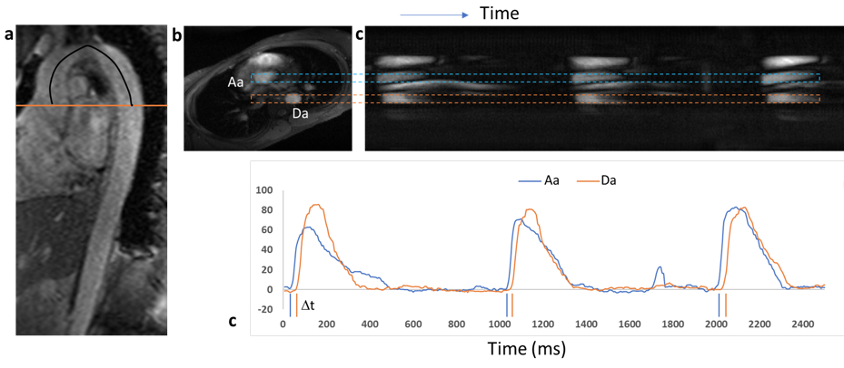 non-cardiac-triggered-aortic-pwv-quantification