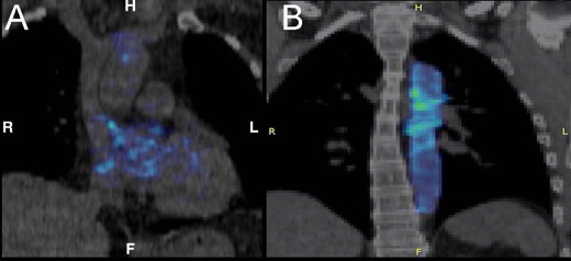 calcified-plaque-in-coronary-arteries-and-aorta