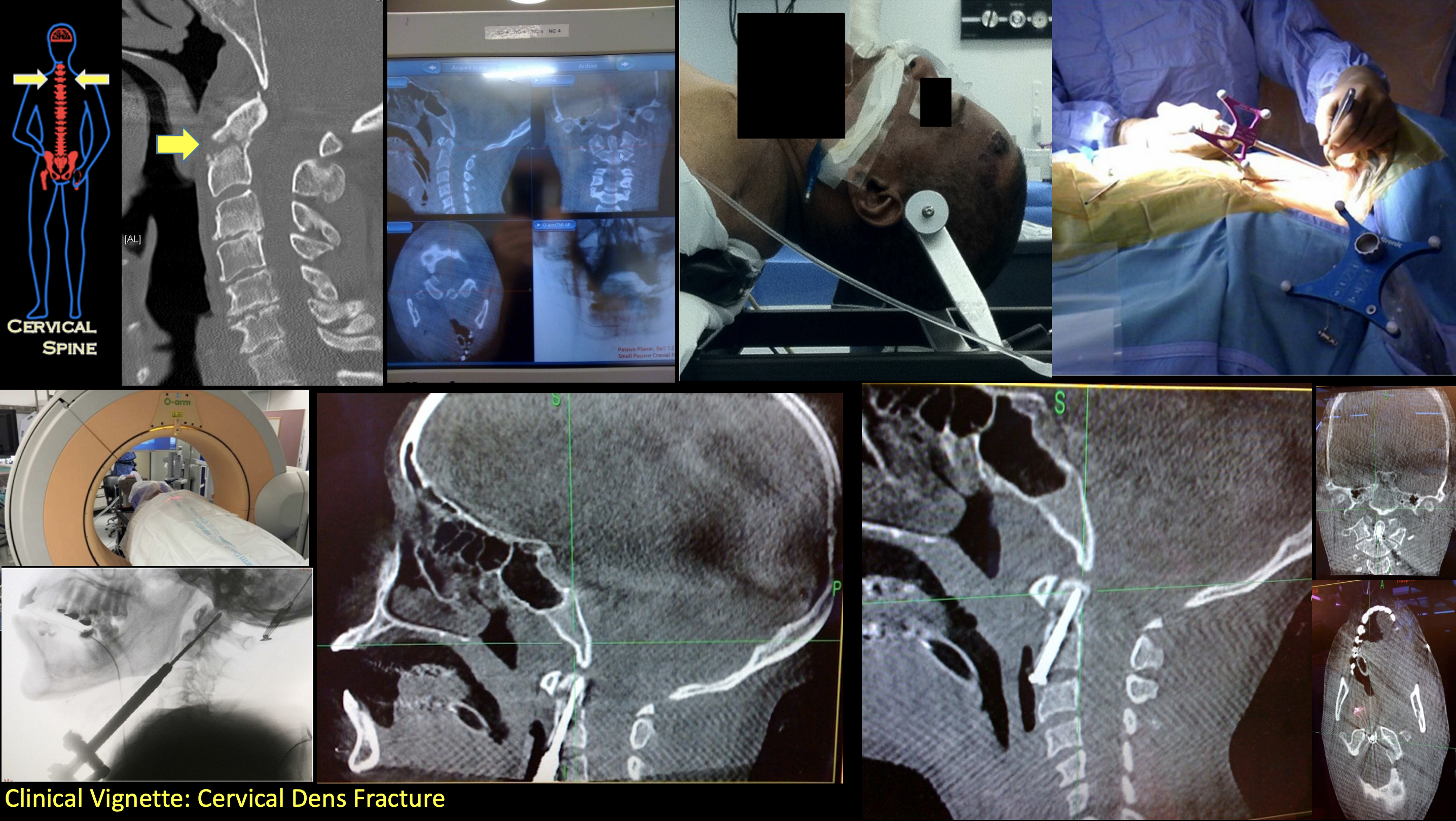 Lumbar Sarcoma