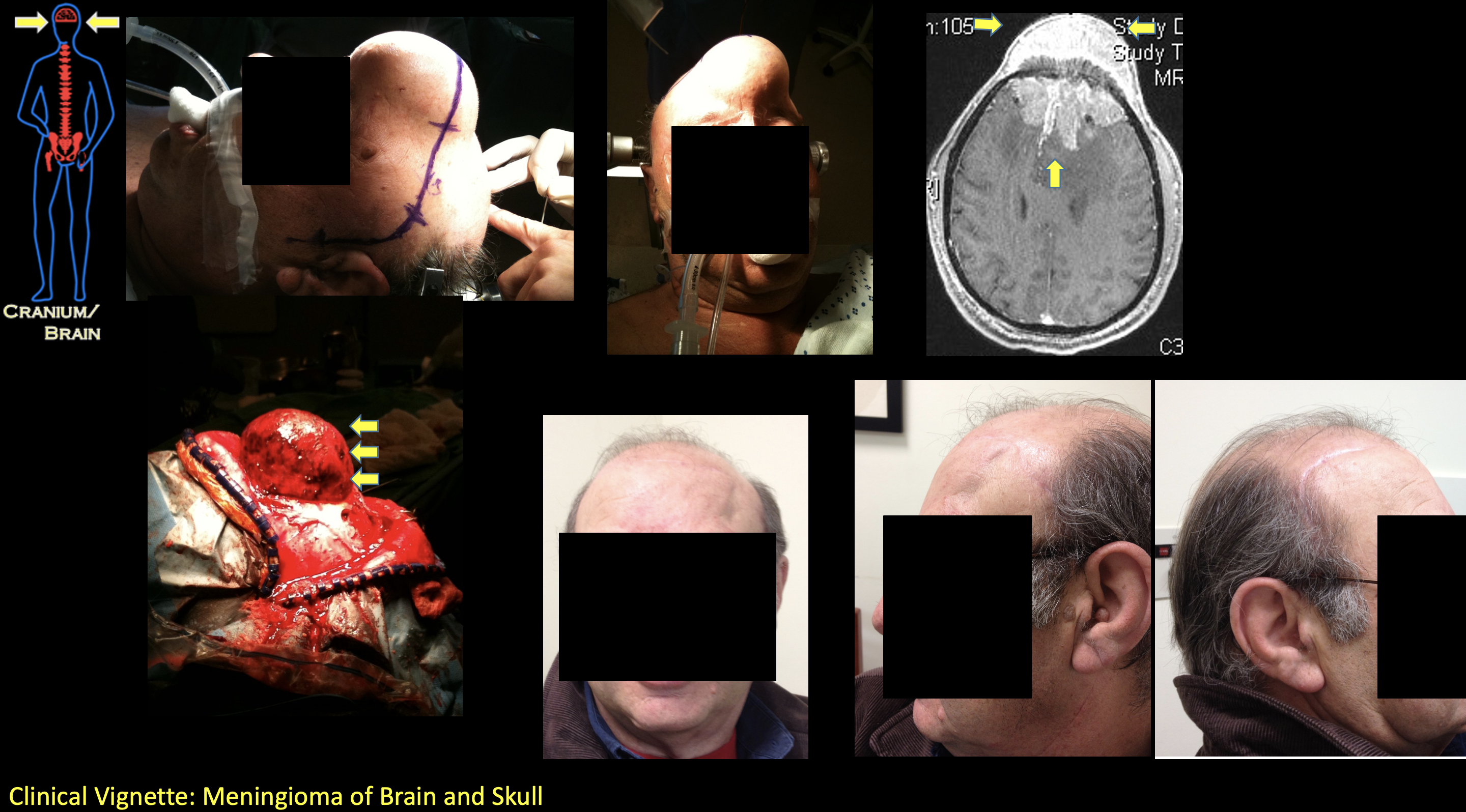 Meningioma of Brain and Skull