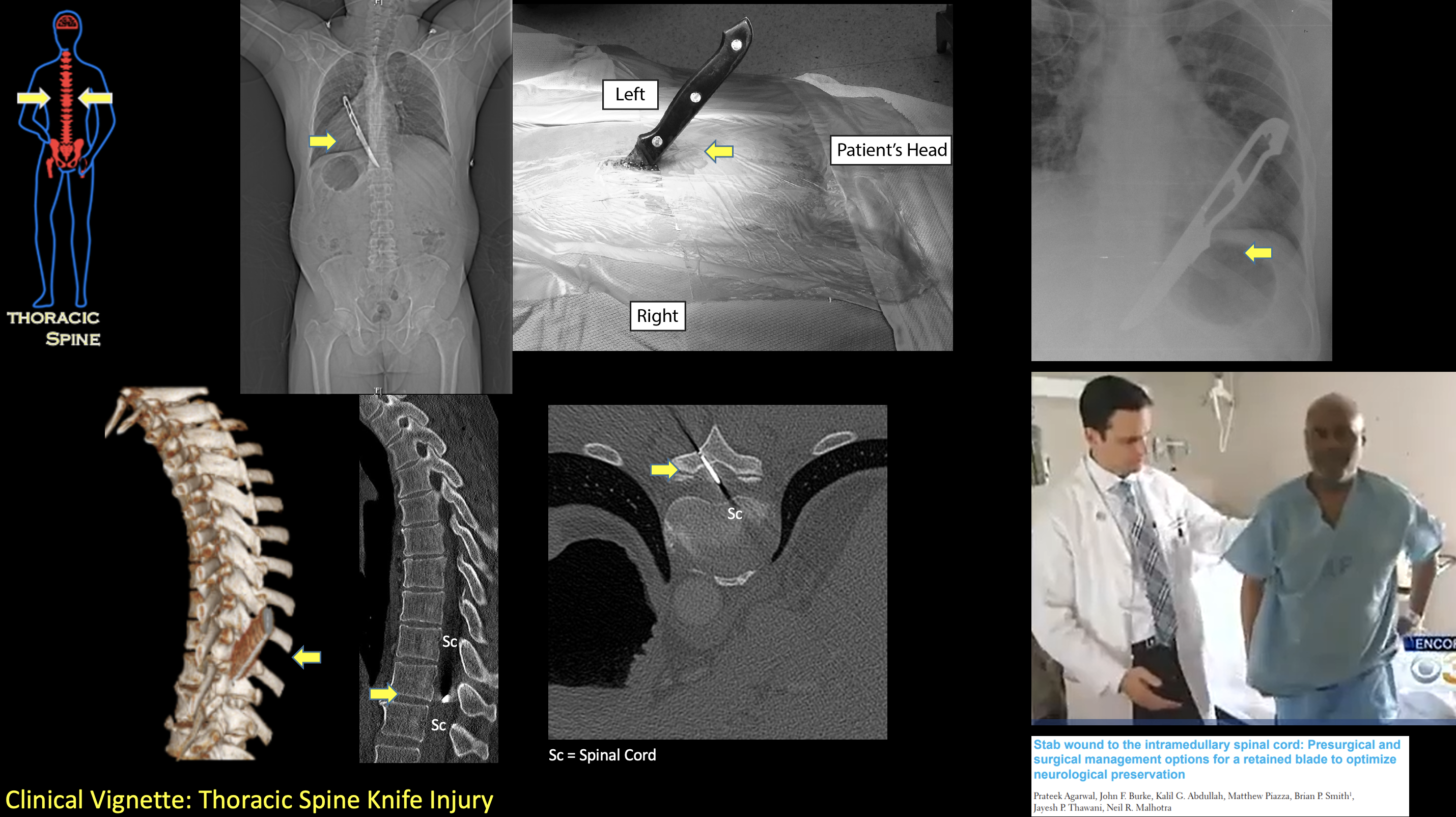 Thoracic Spine Knife Injury