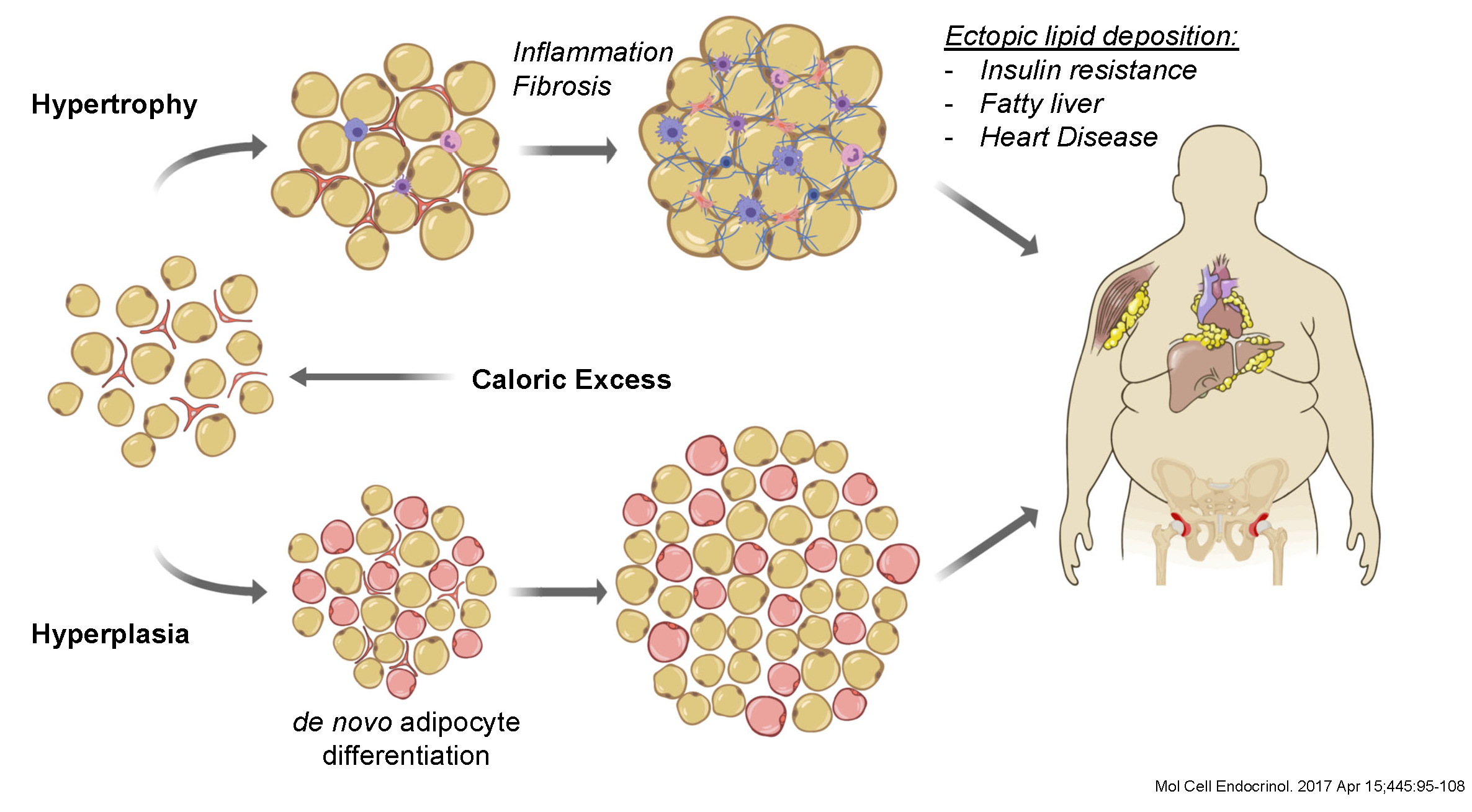 Diagram showing Ectopic lipid deposition