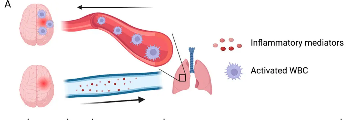 Targeted Nanocarriers Co-Opting Pulmonary Intravascular Leukocytes for Drug Delivery to the Injured Brain