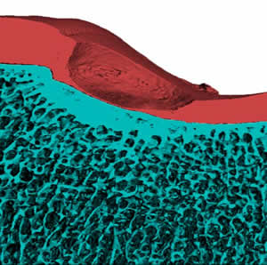 Focal defect in minipig cartilage imaged by microCT 