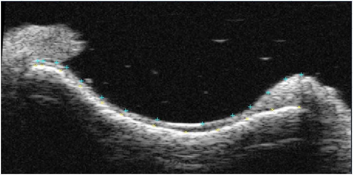 Cartilage ultrasound