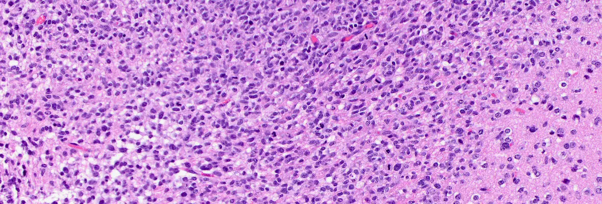 Banner Image of an invasive high-grade glioma