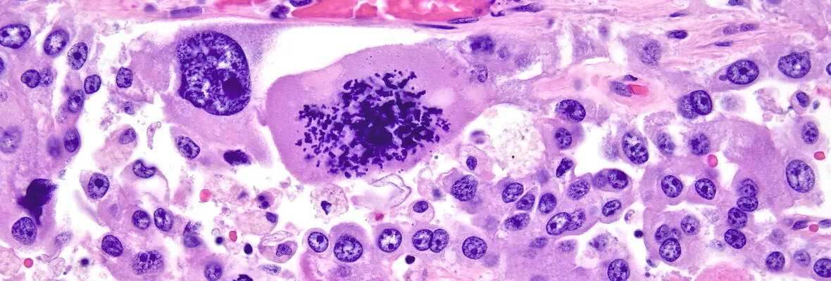 H&E slide of Anaplastic carcinoma