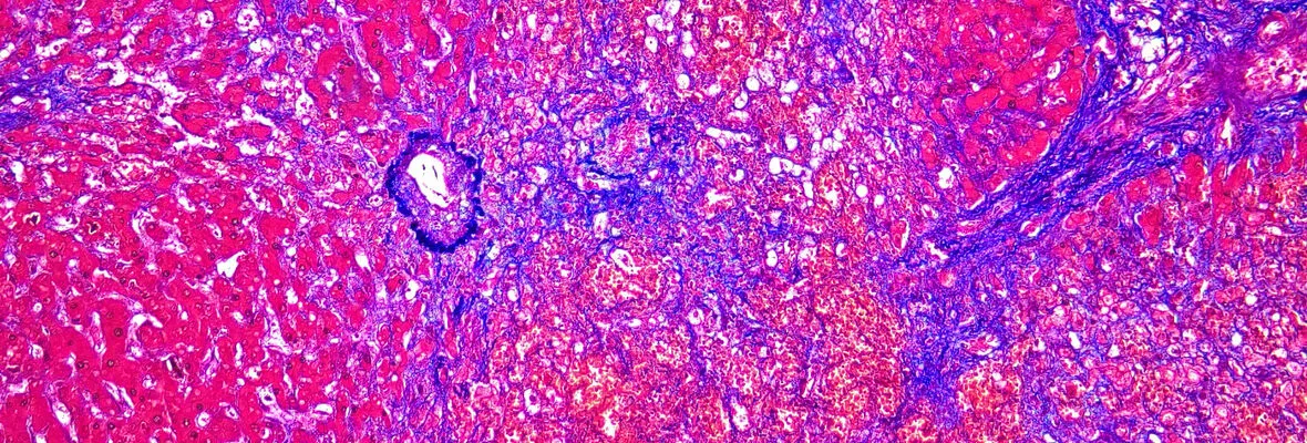 Trichrome slide of Fibrosis of the liver in acute Budd-Chiari