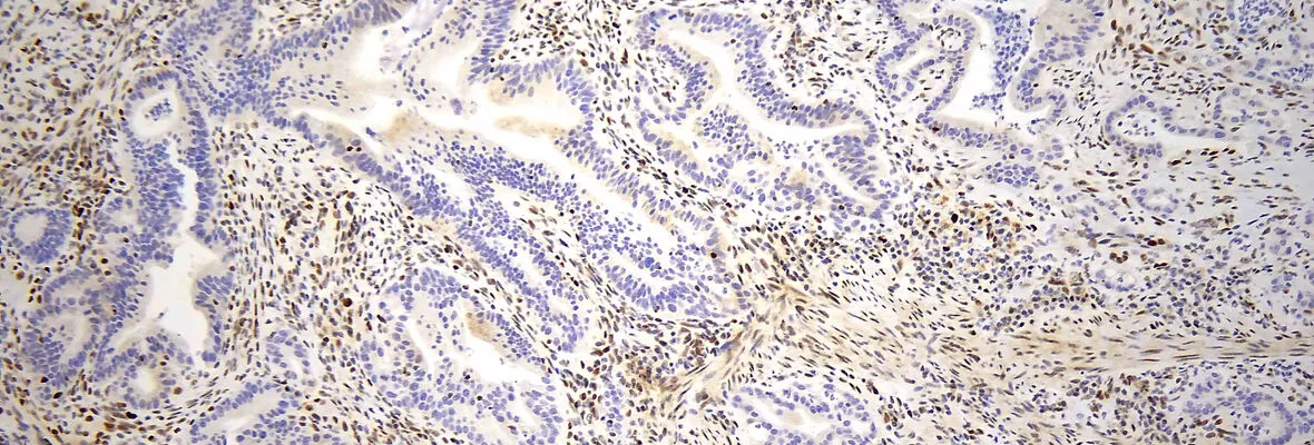 Slide image of MSH6 loss in a small intestinal adenocarcinoma